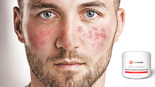 Krem na trądzik różowaty – warto kupić?