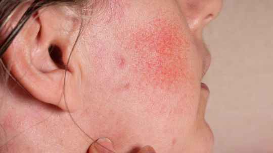Pojawianie się grudek i krostek – codzienne wyzwania związane z trądzikiem różowatym